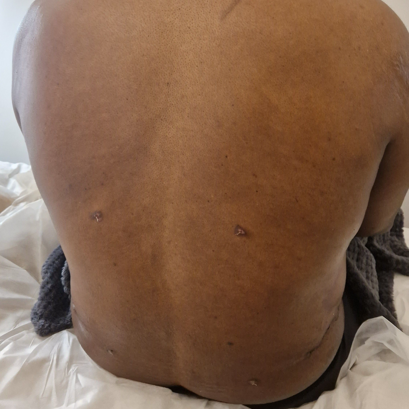 post lymphatic-drainage treatment